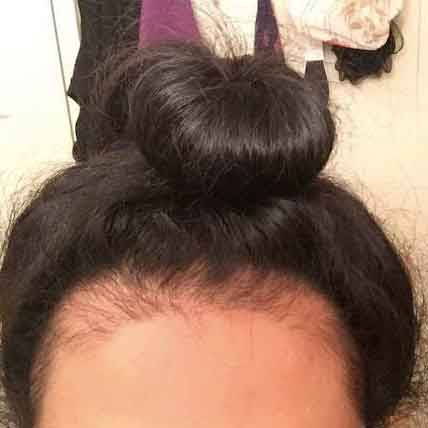ریزش مو کششی