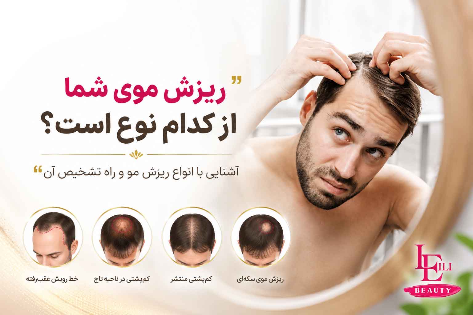 انواع ریزش مو