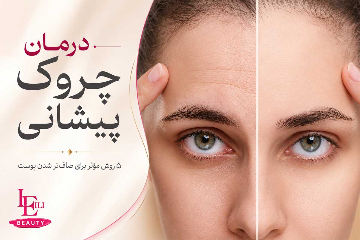 تصویر درمان چروک پیشانی